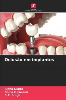 Oclusão em implantes