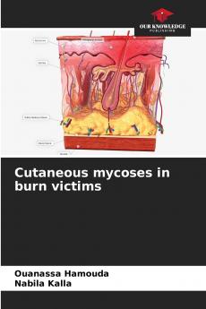 Cutaneous mycoses in burn victims