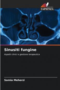 Sinusiti fungine