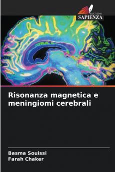 Risonanza magnetica e meningiomi cerebrali