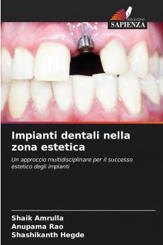 Impianti dentali nella zona estetica