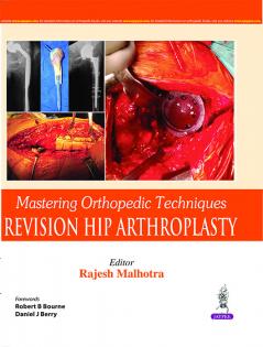 MASTERING ORTHOPEDIC TECHNIQUES REVISION HIP ARTHROPLASTY