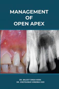 MANAGEMENT  OF  OPEN APEX