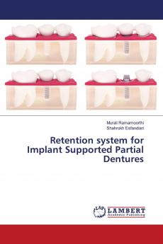 Retention system for Implant Supported Partial Dentures