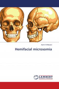 Hemifacial microsomia
