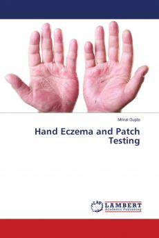 Hand Eczema and Patch Testing