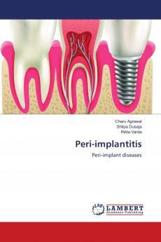 Peri-implantitis