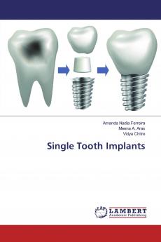 Single Tooth Implants