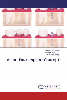 All on Four Implant Concept