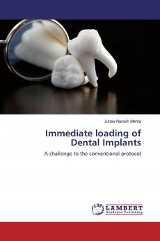 Immediate loading of Dental Implants