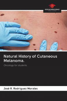 Natural History of Cutaneous Melanoma.
