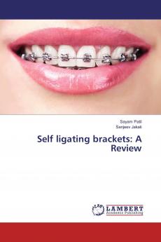 Self ligating brackets: A Review