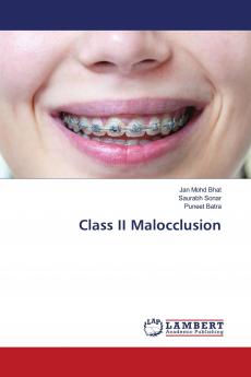 Class II Malocclusion