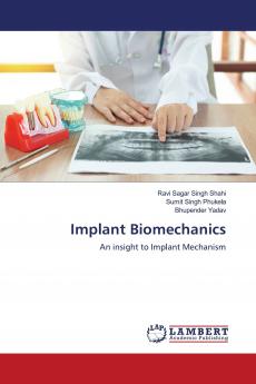 Implant Biomechanics