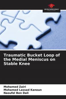 Traumatic Bucket Loop of the Medial Meniscus on Stable Knee
