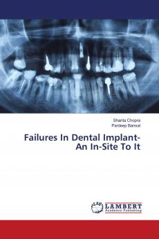 Failures In Dental Implant- An In-Site To It