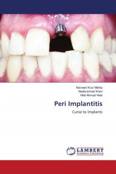 Peri Implantitis