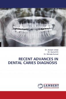 RECENT ADVANCES IN DENTAL CARIES DIAGNOSIS