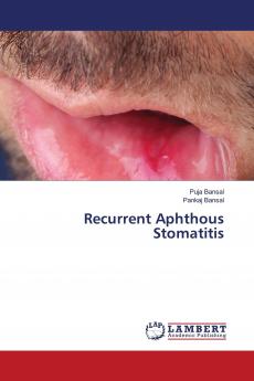 Recurrent Aphthous Stomatitis