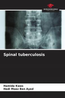 Spinal tuberculosis