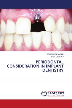 PERIODONTAL CONSIDERATION IN IMPLANT DENTISTRY
