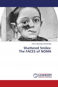 Shattered Smiles: The FACES of NOMA