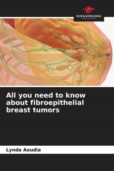 All you need to know about fibroepithelial breast tumors