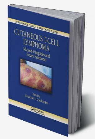 Cutaneous T-Cell Lymphoma