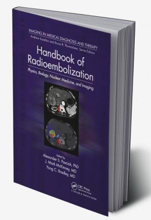 Handbook of Radioembolization