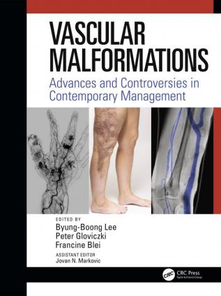 Vascular Malformations