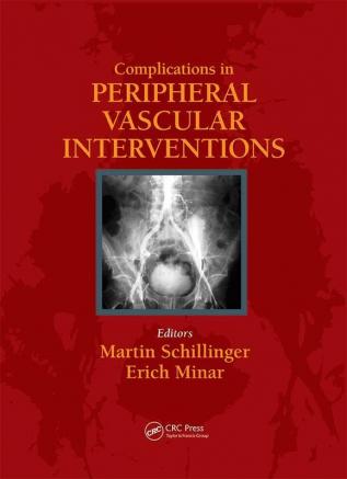 Complicatons in Peripheral Vascular Interventions