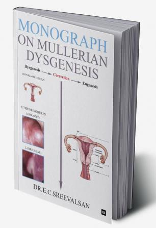 Monograph on Mullerian Dysgenesis