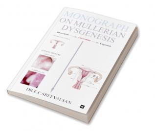 Monograph on Mullerian Dysgenesis