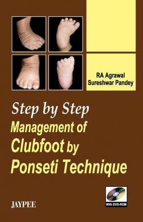 Step by Step Management of Clubfoot by Ponseti Technique (with DVD-ROM)