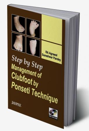 Step by Step Management of Clubfoot by Ponseti Technique (with DVD-ROM)