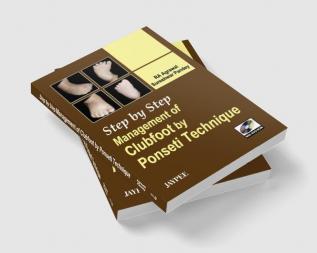 Step by Step Management of Clubfoot by Ponseti Technique (with DVD-ROM)