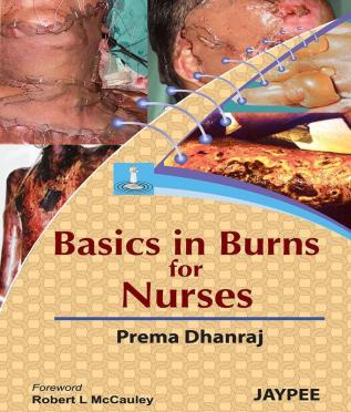 Basics in Burns for Nurses