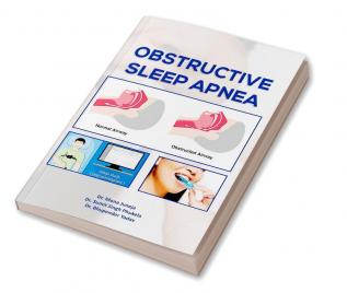 Obstructive Sleep Apnea