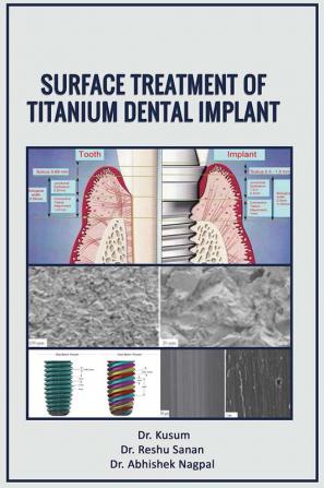 SURFACE TREATMENT OF TITANIUM DENTAL IMPLANT