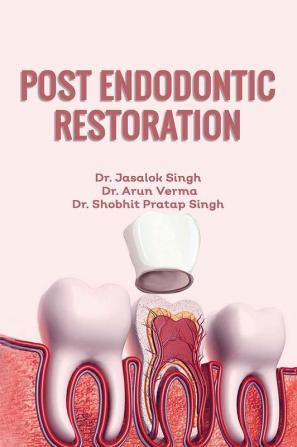 Post Endodontic Restoration