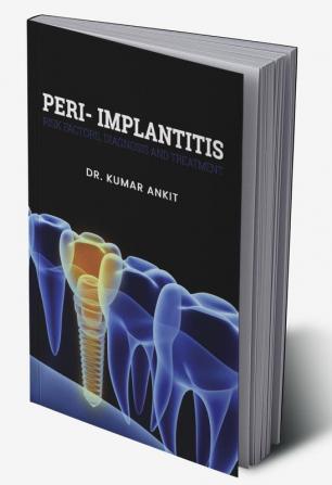 Peri-Implantitis:  Risk Factors Diagnosis And Treatment