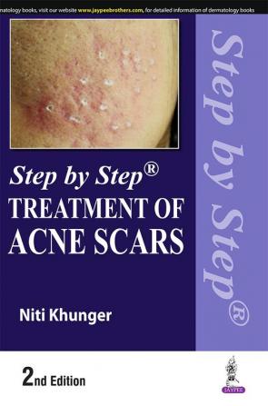 Step by Step Treatment of Acne Scars 2nd edition