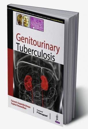 GENITOURINARY TUBERCULOSIS