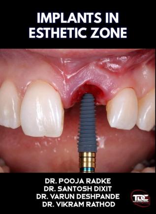 Implants In Esthetic Zone