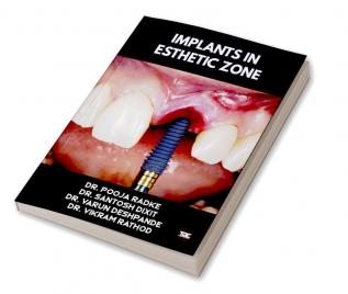 Implants In Esthetic Zone