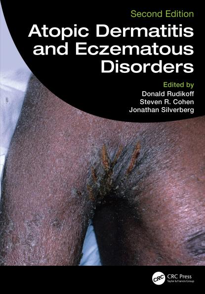 Atopic Dermatitis and Eczematous Disorders