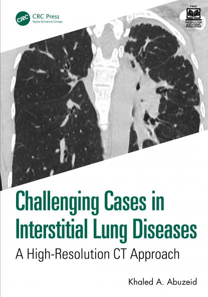 Challenging Cases in Interstitial Lung Diseases