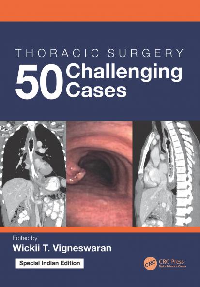 Thoracic Surgery: 50 Challenging cases