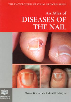 Atlas of Diseases of the Nail