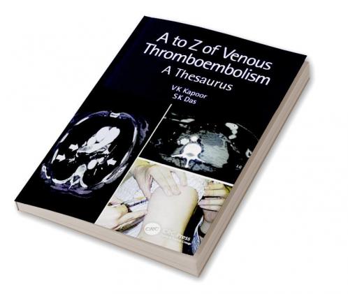A to Z of Venous Thromboembolism